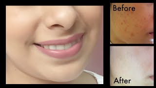 How to Get Rid of Dark Spots Acne Scars  Get Fairer amp Clear Skin [upl. by Asyen274]