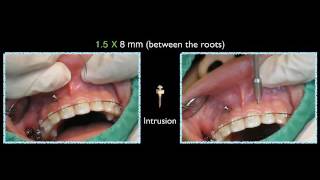 How to Put OBS 15 at Anterior Position [upl. by Noonberg830]