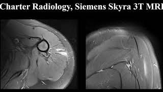 Shoulder MRI Osteochondromatosis [upl. by Farmelo]