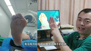 hallux valgus 拇外翻会不会其余器官造成影响和损伤？ [upl. by Nahtanoj]