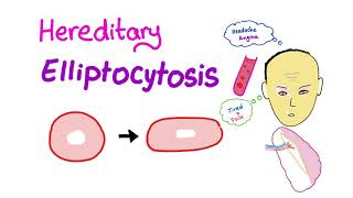 Hereditary Elliptocytosis HE [upl. by Moina836]