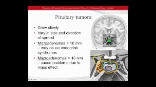 Management Options for Pituitary Tumors [upl. by Nakre]