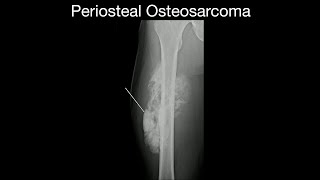 Periosteal Osteosarcoma [upl. by Rask868]