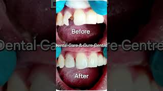 Composite filling before and after [upl. by Ramel]