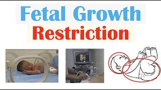 Fetal Growth Restriction FGR IUGR  Types Causes TORCH Infections Diagnosis Treatment [upl. by Llerod]