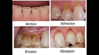 cervical lesion شرح [upl. by Tebazile]