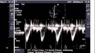 Point of Care Echo Stroke Volume Determination [upl. by Klarrisa]