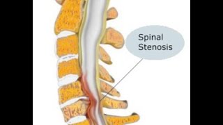 Estenosis Espinal [upl. by Nodal]