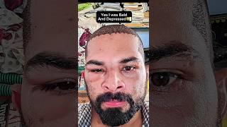 My Hair Transplant Results💥💥💥ameerht hairtransplant hairlosstreatment [upl. by Illib]