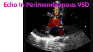 Echo In Perimembranous VSD [upl. by Evelin]