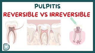 Reversible Pulpitis Vs Irreversible Pulpitis Symptoms Diagnosis Testing and Management [upl. by Anada]