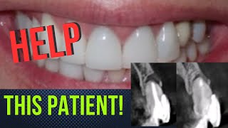 Preserve Teeth Harnessing Patients Healing Ability [upl. by Lyndel916]