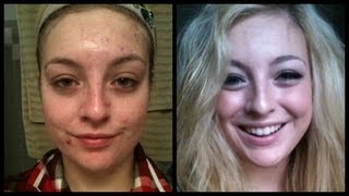 End of Accutane Before and After [upl. by Dloniger977]