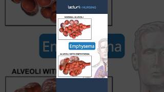 Exploring Emphysema 🔍 Emphysema RespiratoryCare nclexrn [upl. by Anawat782]