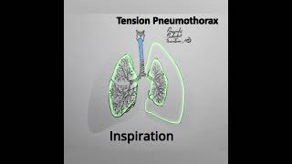 Tension Pneumothorax Animation variation 4 shorts medical [upl. by Enaz394]