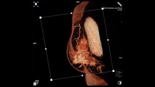 nuview Breast CT Small amp dense breast [upl. by Wolfson]