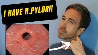 Helicobacter pylori Symptoms And My Experience [upl. by Herta]