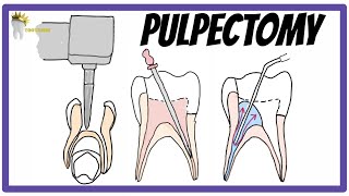 PULPECTOMY  Indications Contraindications Rationale obturation materials [upl. by Henrion]