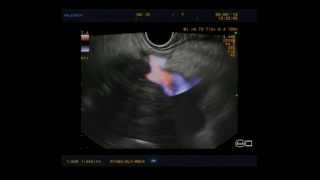 EUS vascular staging of a pancreatic mass [upl. by Nealah737]