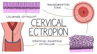 Understanding Cervical Ectropion  Cervical Erosion [upl. by Artiek]