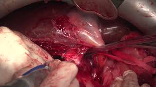 Retroperitoneal liposarcoma with en bloc resection with hepatectomy and vena cava allograft [upl. by Sirrah]