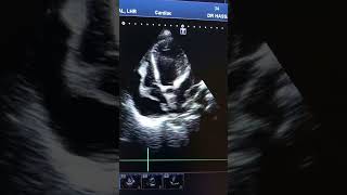 pericardial effusion with cardiac tamponadeecho fcps [upl. by Asilanom]