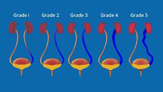 What is Vesicoureteral Reflux VUR  Animated Video [upl. by Nnyleimaj]