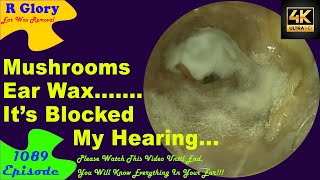 Mushrooms Ear Wax🤣Its Blocked My Hearing🤷‍♂️New Video Ear Wax Removal 1089😍 ear newvideo [upl. by Rimat]