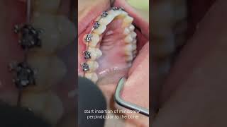 steps of interradicular orthodontic miniscrew DrEslam samir go ahead ortho [upl. by Halika]