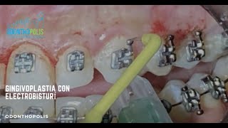 Gingivoplastia Con ElectroBisturí [upl. by Aguie]