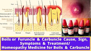 Boils or Furuncle amp Carbuncle Cause Sign Symptoms amp Treatment Homeopathy Medicines amp Allopathy [upl. by Ayoj]