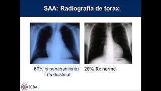 6° Modulo  B Sindromes Aórticos Agudos tipo B [upl. by Buehrer]