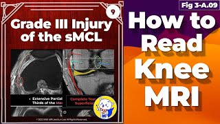 Fig 3A09 Grade III Injury of the sMCL and Medial Patellofemoral Ligament Injuries [upl. by Immot576]