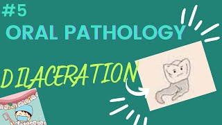 DILACERATION in dentistry [upl. by Eanej900]