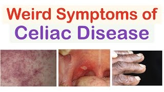 Weird Symptoms of Celiac Disease  Atypical Clinical Features [upl. by Lombardy]