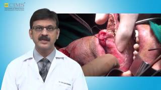 CIMS HOSPITAL  Dr Darshan Bhansali  Mouth Cancer Causes And Treatment [upl. by Intruok]