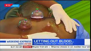 Hijama Islamic way of detoxification [upl. by Dalli]