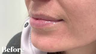 Watch This Lip Filler Transformation With Just One Syringe Of Juvéderm Volbella [upl. by Soraya601]