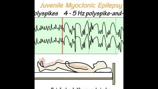 Epilepsia mioclónica juvenil o síndrome de Janz JME [upl. by Hayila489]