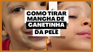 MANEIRA MAIS FÁCIL QUE ENCONTREI DE TIRAR MANCHA DE CANETINHA DA PELE [upl. by Haggerty]