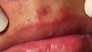 Most Painful Blackhead Removal on Lips [upl. by Airyk]