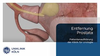 Prostatakrebs  Entfernung der Prostata Klinik für Urologie Patienteninformation  Uniklinik Köln [upl. by Nide]