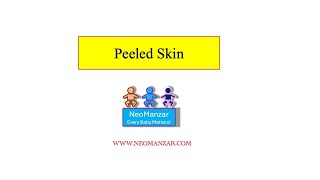 Peeled Skin Newborn Infant [upl. by Cooperman130]