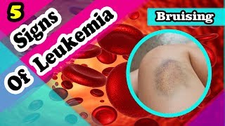 5 Leukemia Signs and Symptoms You Should Know [upl. by Byers894]