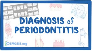 Diagnosis of Periodontitis [upl. by Nino25]