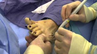 Watch Dr Sherman Nagler perform a Taylors Bunionectomy [upl. by Kenlay128]