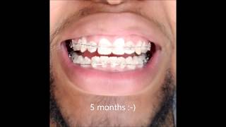 Braces 6 Month Timelapse [upl. by Naesal]