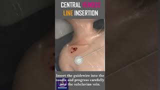 Central Venous Line Insertion  Step By Step Procedure  shorts [upl. by Ttnerb]