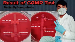 CAMP Test result  Butterfly haemolysis  CAMP Test factor  ve amp ve CAMP Test  Enhanced Haemolys [upl. by Joycelin349]