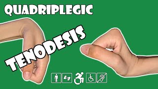 Tenodesis  Explained  Quadriplegic C5C6C7 [upl. by Aneehsak]